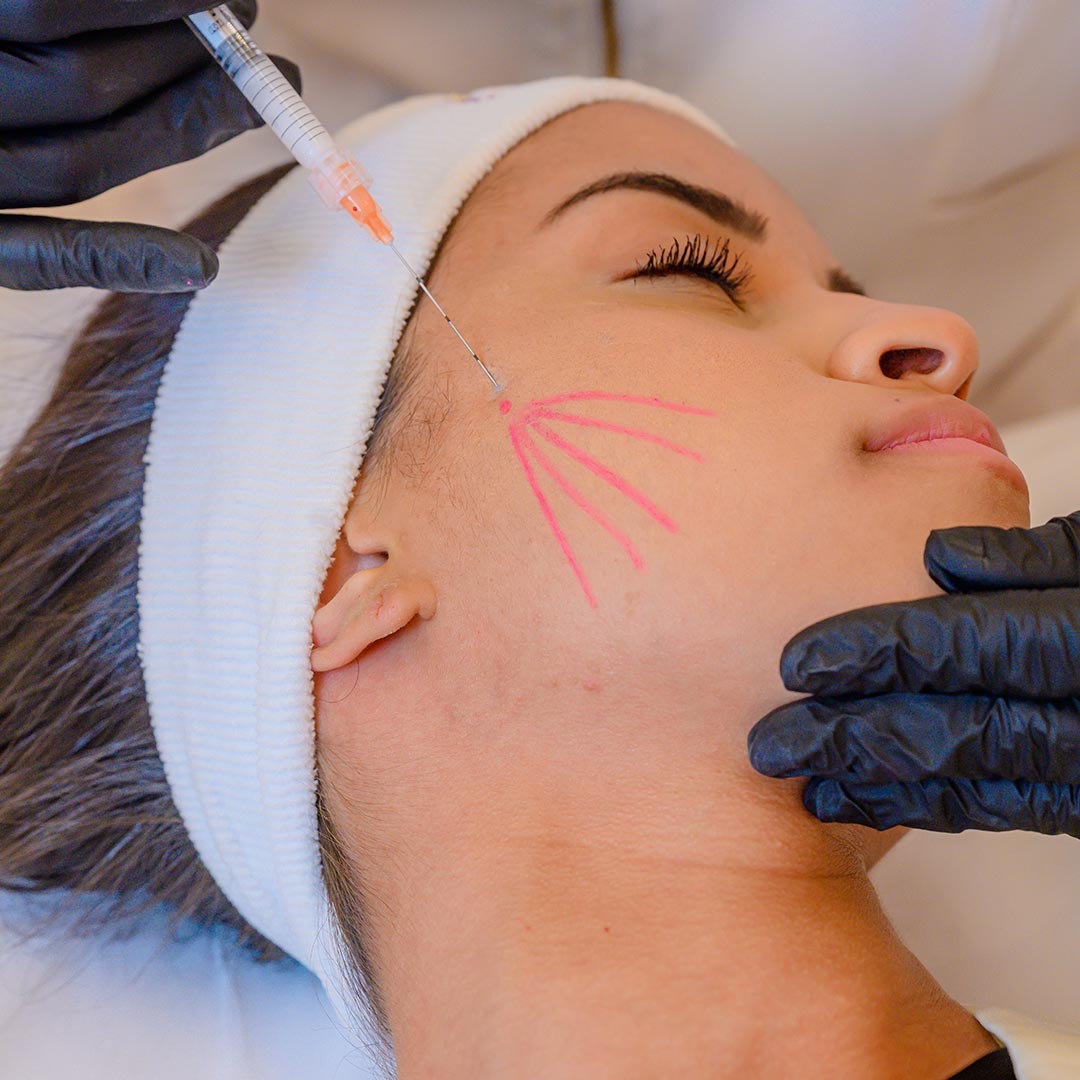 Bioestimulador de Colágeno para rejuvenescimento