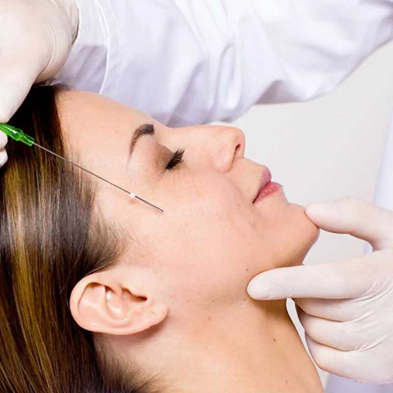 Fios de PDO para lifting facial