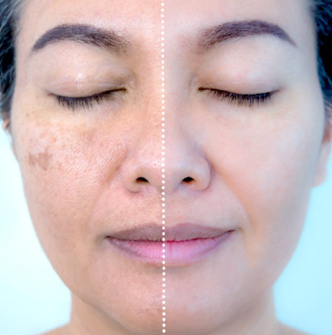 Tratamento de Melasma com Microagulhamento