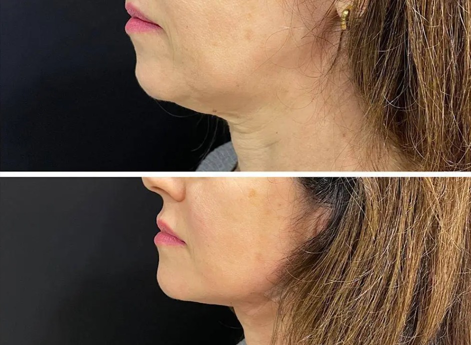 Tratamento de Papada (Queixo Duplo)